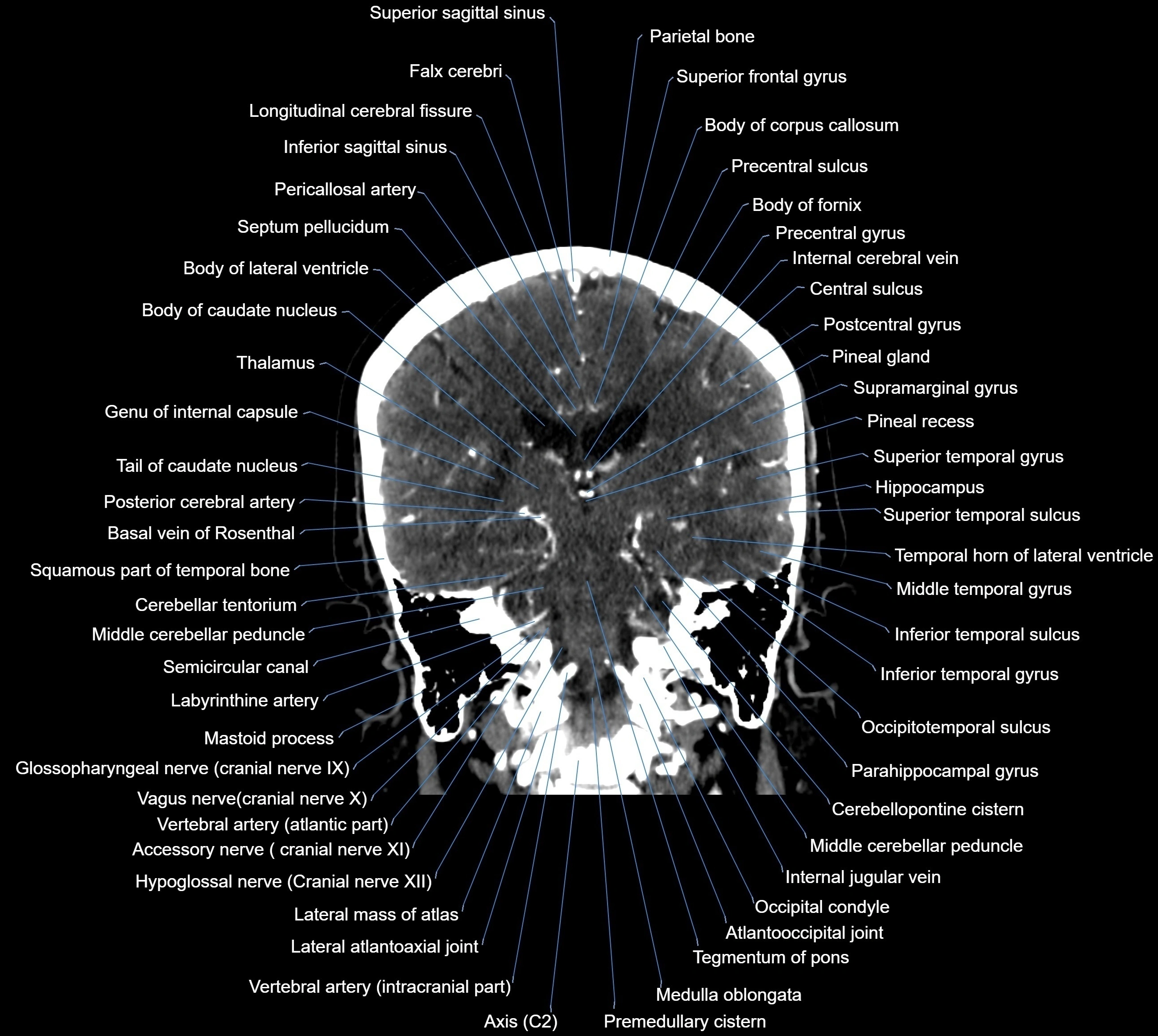 CT Brain coronal cross sectional radiology anatomy image  -img-00001-028.webp